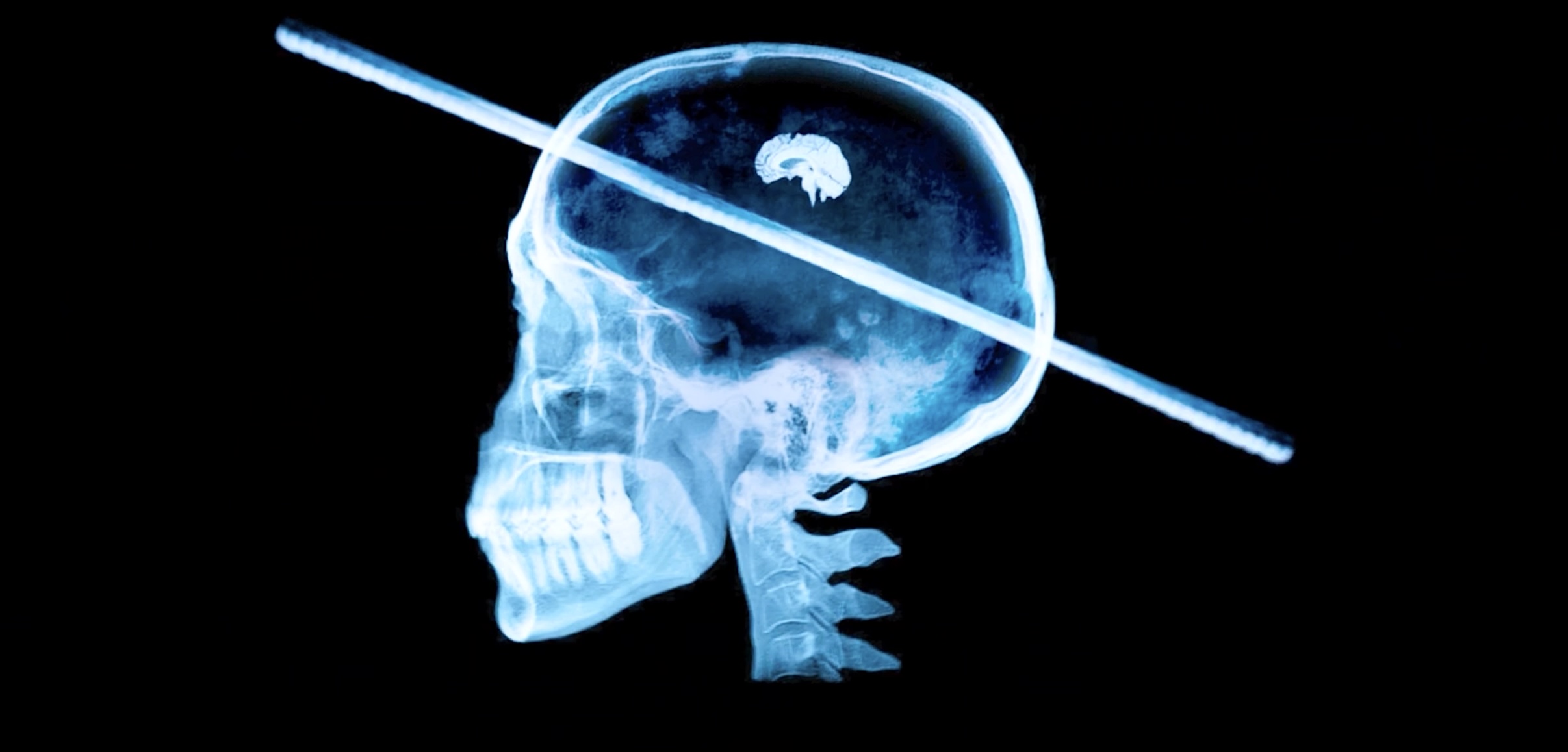 Um raio-x simulado, mostrando uma vista lateral de um crânio humano e vértebra, com um poste percorrido pelo crânio, perdendo completamente o pequeno cérebro escondido no topo do crânio. De Escape ao século 21